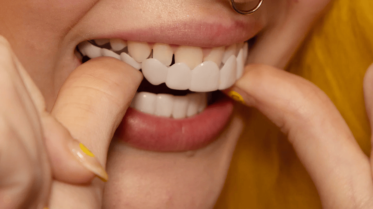 TandVorm Snap-On Tanden Veneers – Directe Glimlach Correctie voor Onregelmatige of Ontbrekende Tanden