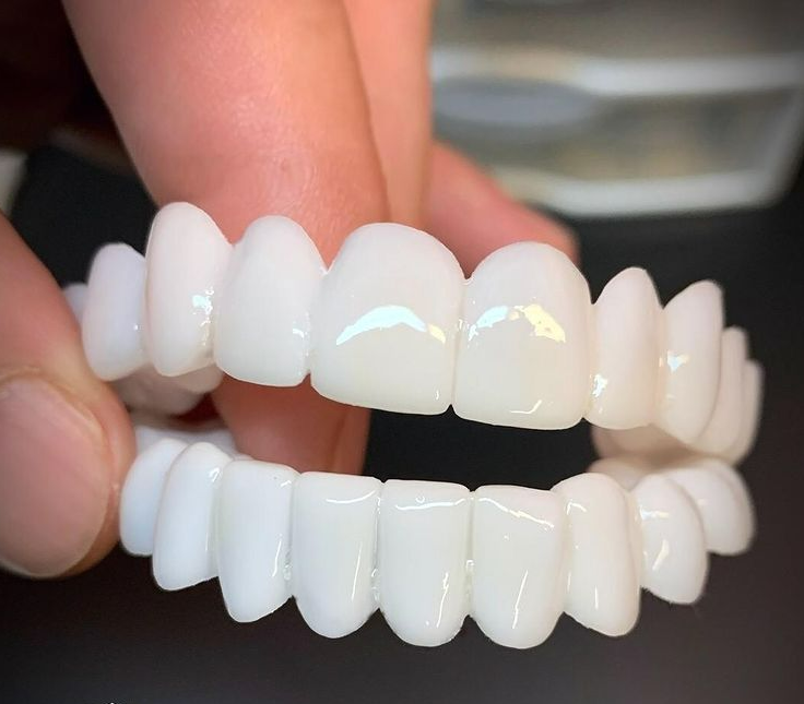 Smile Lens – Verstelbare Witte Tandprothese voor Directe Glimlachcorrectie