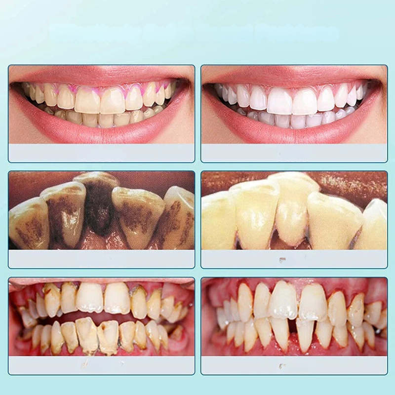 SmilePro Ultrasone Tandsteenreiniger – Effectieve Plaqueverwijderaar voor Thuis