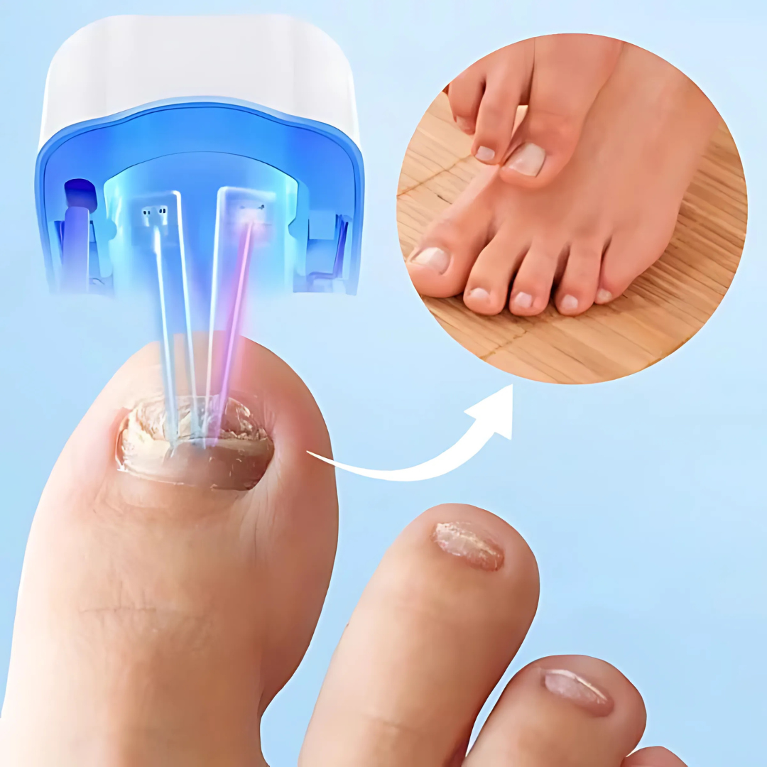 NailClear Laser Nagelschimmel Behandelapparaat – Infrarood Thuisbehandeling