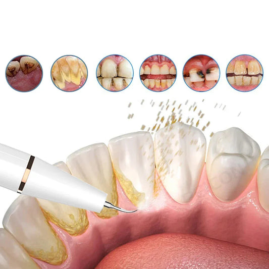 SmilePro Ultrasone Tandsteenreiniger – Effectieve Plaqueverwijderaar voor Thuis